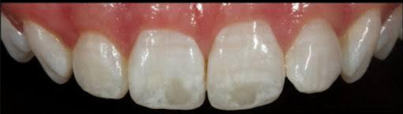 Remoção de manchas brancas com resina infiltrante