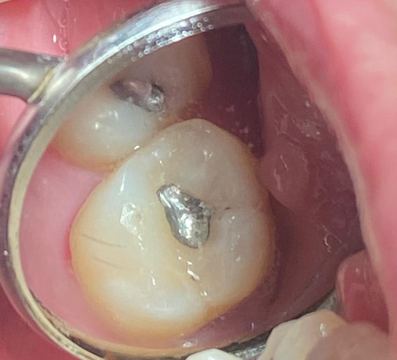 Troca de restauração de metal por restauração em resina